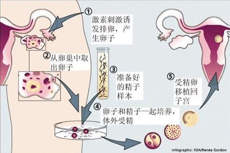 ICSI操作
